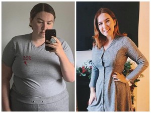 Kondisi Langka! Wanita Ini Harus Dioperasi karena Tak Bisa Berhenti Makan