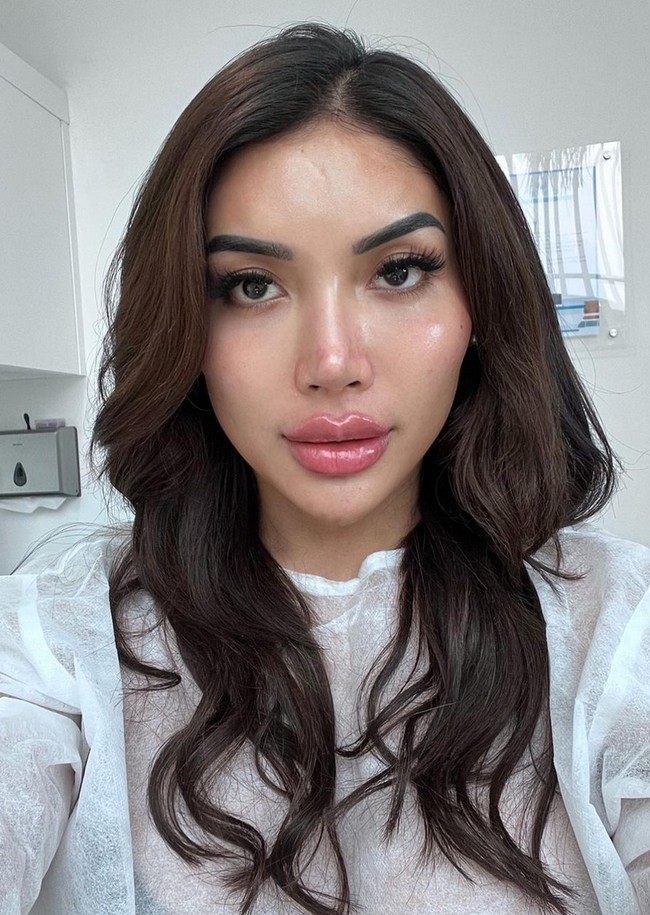 Millen Cyrus pun memperlihatkan wajahnya sesaat setelah suntik filler. Dia menjelaskan kalau saat ini wajahnya masih bengkak dan perlahan-lahan hasilnya akan lebih alami. Foto: Instagram/@millencyrus