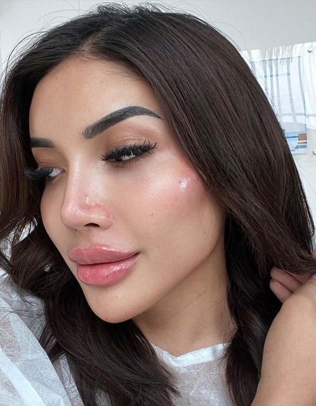 Perawatan suntik filler dilakukan untuk mendapatkan profil wajah yang lebih tegas. Ia menyebut prosedur tersebut sebagai ‘Millen’s contour Jolie’. Foto: Instagram/@millencyrus