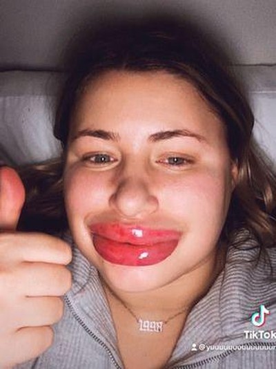 Alergi filler Alergi filler
