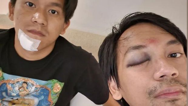 Luka yang dialami Rian dan Rama d'Masiv.