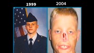 Kisah Pria yang Kesetrum Hingga Wajahnya Meleleh, Butuh Transplantasi Wajah
