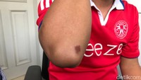 Selain bengkak dan memar di mata, Rian DMasiv juga mengalami luka-luka di beberapa bagian tubuhnya, salah satunya luka pada bagian sikut tangannya. Foto: Hanif/detikHOT
