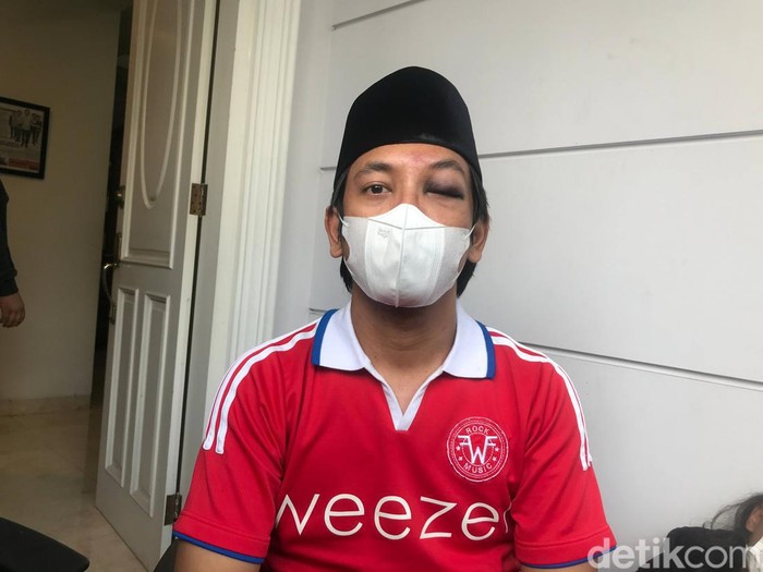 Rian D'Masiv perlihatkan matanya yang memar dan bengkak.