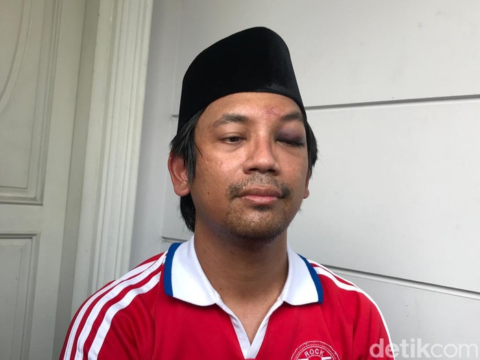 Rian D'Masiv Rian D'Masiv perlihatkan matanya yang memar dan bengkak.