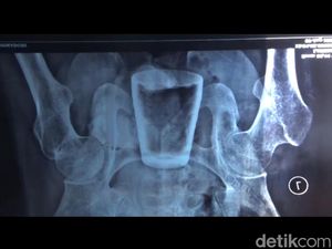 RSD Balung: Gelas Bukan di Perut Tengah Nurlasiadi, Tapi Dekat Anus