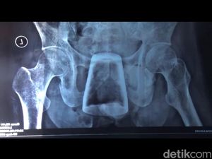 Di Sini Posisi Gelas Kaca yang Ada Dalam Tubuh Pria Jember