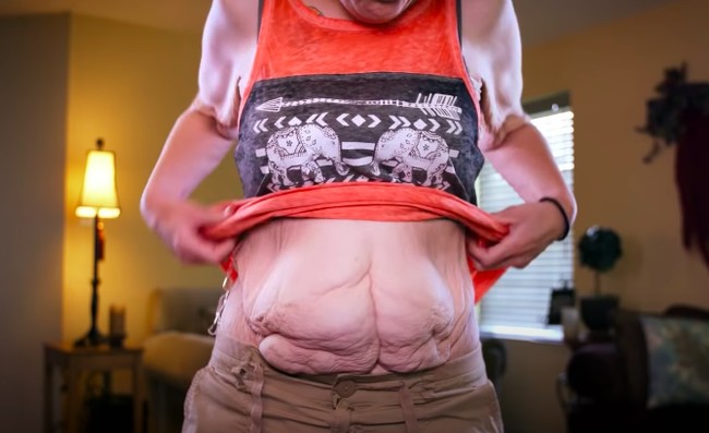 Dan seperti inilah bagian perutnya yang sangat tidak disukai Anna. “Ada lebih dari satu area di perutku yang menggantung, aku merasa itu terlihat seperti daging hamburger,” tuturnya sedih. Foto: dok. Youtube/TLC UK