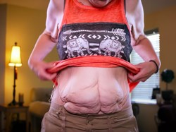 Foto: Transformasi Wanita Berhasil Turun BB 153 Kg, Tapi Bikin Miris