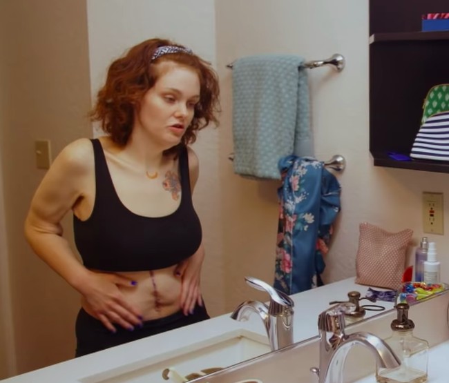 Tidak ada lagi daging menggelambir. Kulit di area perutnya pun sudah terangkat sehingga kini lebih kecil. Foto: dok. Youtube/TLC UK