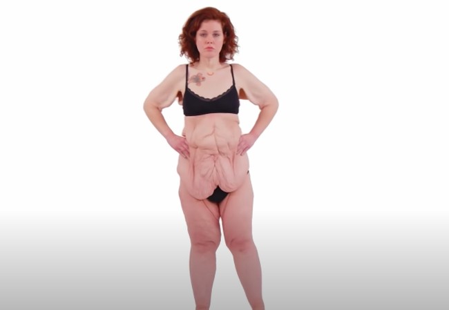 Ketika Anna mencapai berat badan yang diinginkan, dia tidak merasa bahagia. Anna merasa sedih dan jijik dengan kelebihan kulitnya. “Aku merasa menjijikan dan aku membenci tubuhku,” akunya. Foto: dok. Youtube/TLC UK