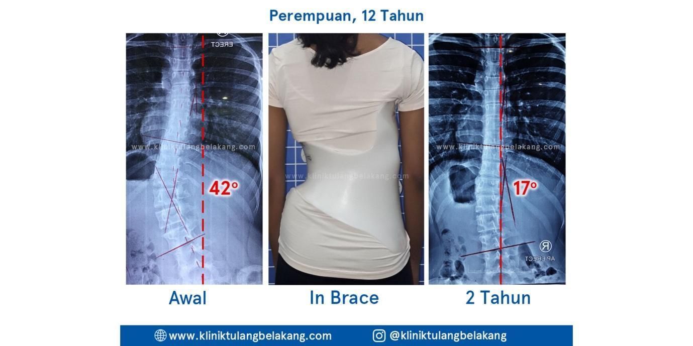 Klinik Tulang Belakang