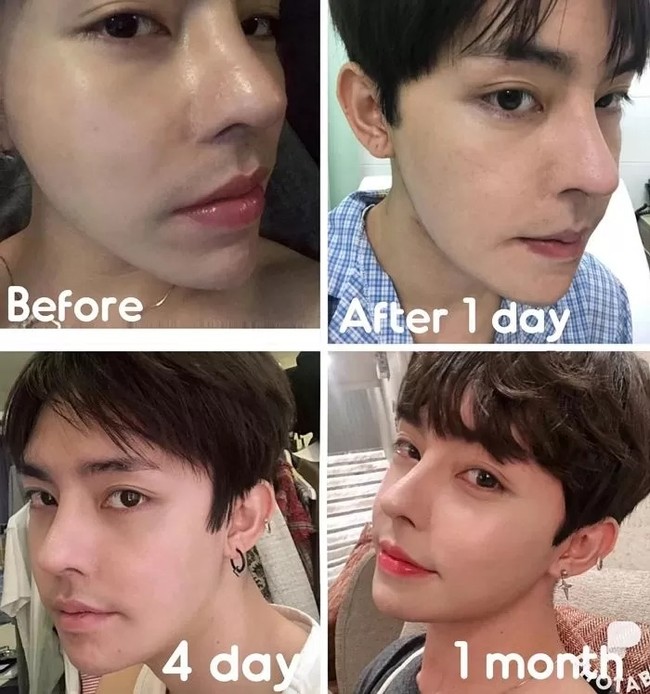 Selama belasan tahun, pria asal kota Na Dang itu menjalani operasi plastik untuk mengubah bentuk hidung, bibir, dagu, hingga tulang pipi. Meskipun begitu proses yang dihadapinya tidak mudah dan menyakitkan. Foto: dok. Instagram @taiyang_official