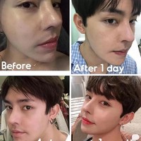 Selama belasan tahun, pria asal kota Na Dang itu menjalani operasi plastik untuk mengubah bentuk hidung, bibir, dagu, hingga tulang pipi. Meskipun begitu proses yang dihadapinya tidak mudah dan menyakitkan. Foto: dok. Instagram @taiyang_official