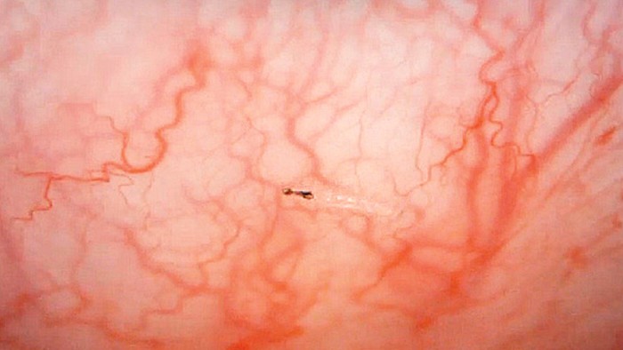 Dokter Temukan Puluhan Belatung Bersarang di Mata Pria Ini Dokter Temukan Puluhan Belatung Bersarang di Mata Pria Ini