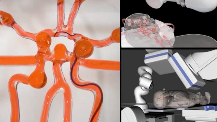 Robot Bedah Stroke