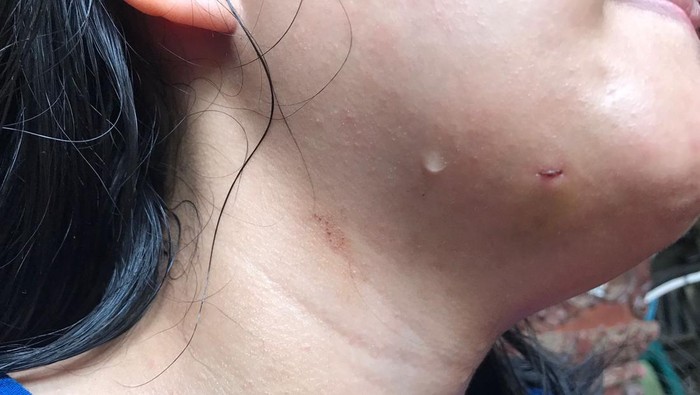 Penampakan luka pada dagu anak yang diviralkan digorok ibu di Jaktim