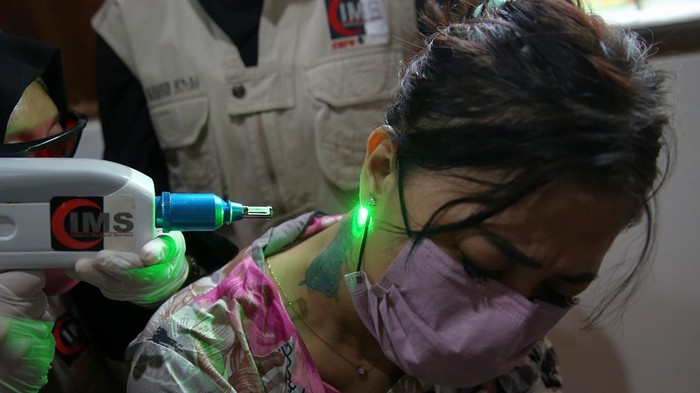 Peserta mengikuti kegiatan hapus tato gratis di Kantor DPP FUHAB, Kebayoran Baru, Jakarta Selatan, Selasa (19/4/2022).