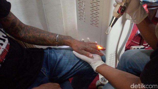 Proses menghapus tato dengan laser