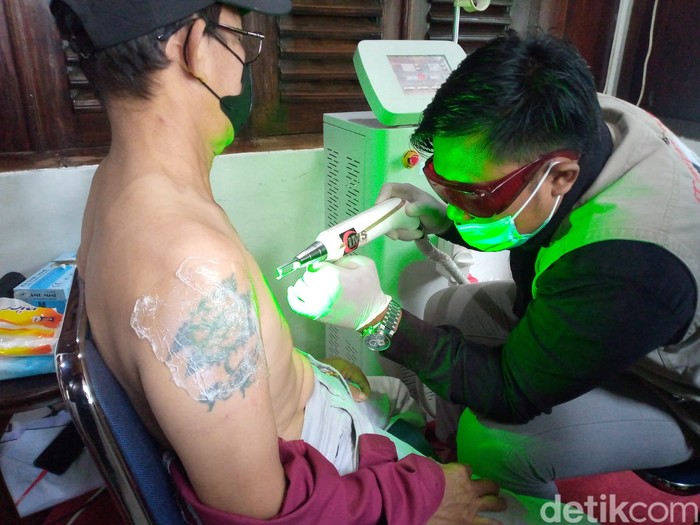 Menghapus tato dengan laser