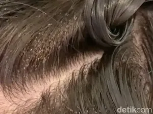 7 Cara Menghilangkan Kutu Rambut dan Kenali Penyebabnya Agar Terhindar