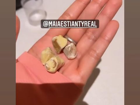 Bentuk batu empedu dari dalam tubuh Maia Estianty/