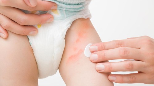 Young adult mother hand applying white medical ointment on toddler leg. Red rash on skin from diaper. Care about baby body. Closeup. Front view. Isolated on light gray background.