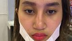 Before & After! Putri Farida Nurhan Implan Hidung