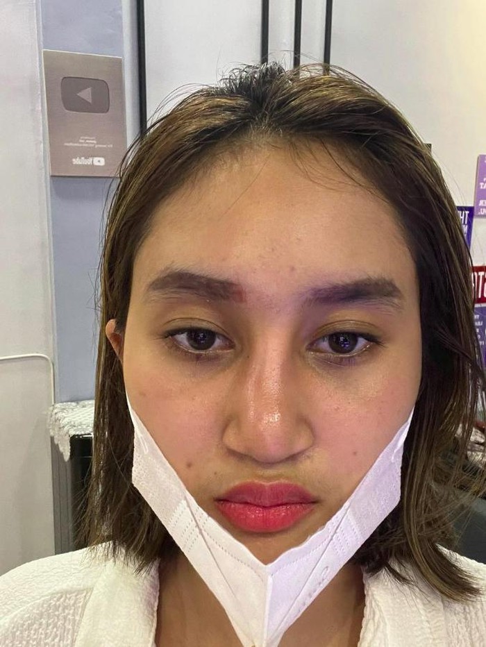 Penampian putri Farida Nurhan sebelum dan sesudah implan hidung.