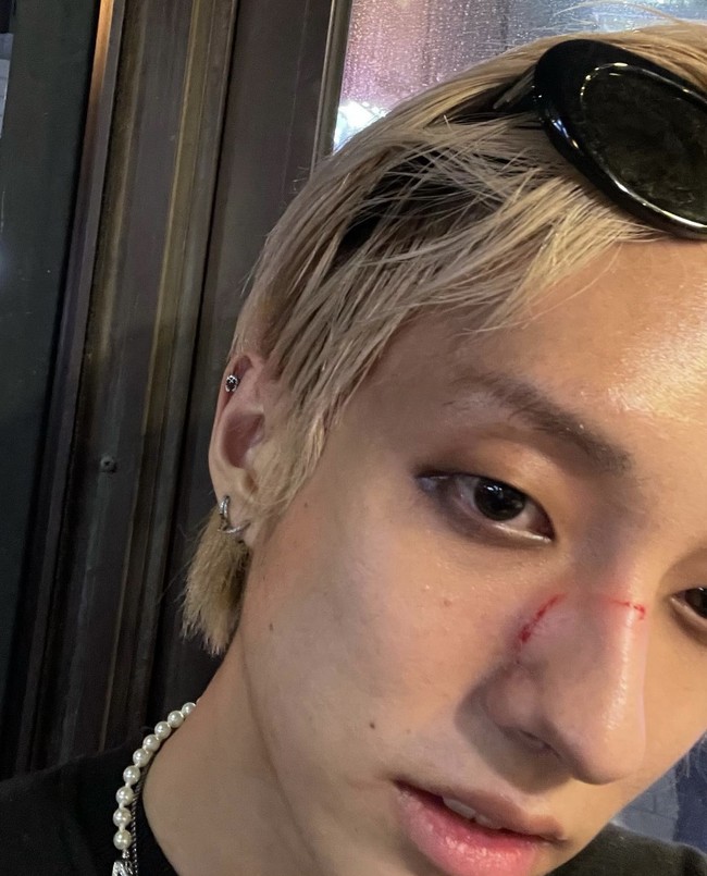 Baru-baru ini, HOLLAND memberikan kabar mengejutkan setelah diserang pria tak dikenal di kawasan Itaewon, Seoul. Wajahnya dipukuli sebanyak dua kali sebelum diserang dengan ejekan “pria gay kotor.” Foto: dok. Instagram @holland_vvv