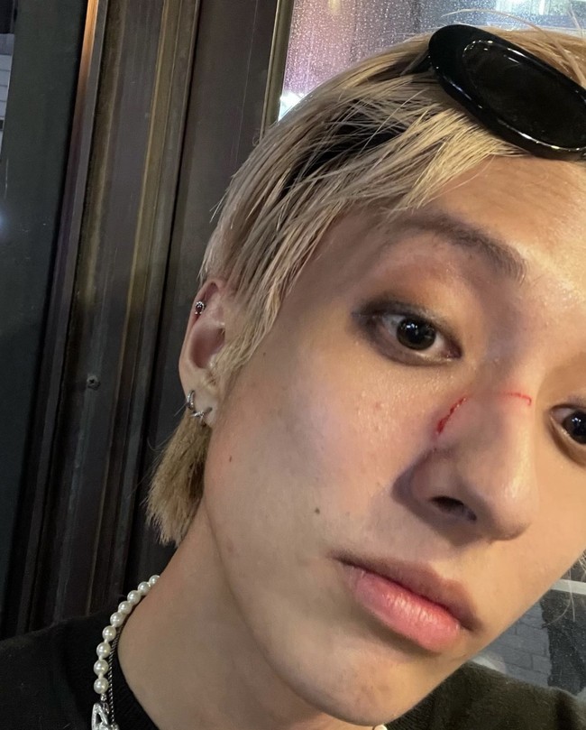 Saat pergi ke rumah sakit, HOLLAND menemukan dirinya mendapat memar di bagian belakang hidung, di samping hidung, dan mata kirinya. Lebih lanjut HOLLAND menceritakan dia mendapat banyak komentar negatif saat diberitakan di Korea. Foto: dok. Instagram @holland_vvv