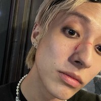 Saat pergi ke rumah sakit, HOLLAND menemukan dirinya mendapat memar di bagian belakang hidung, di samping hidung, dan mata kirinya. Lebih lanjut HOLLAND menceritakan dia mendapat banyak komentar negatif saat diberitakan di Korea. Foto: dok. Instagram @holland_vvv