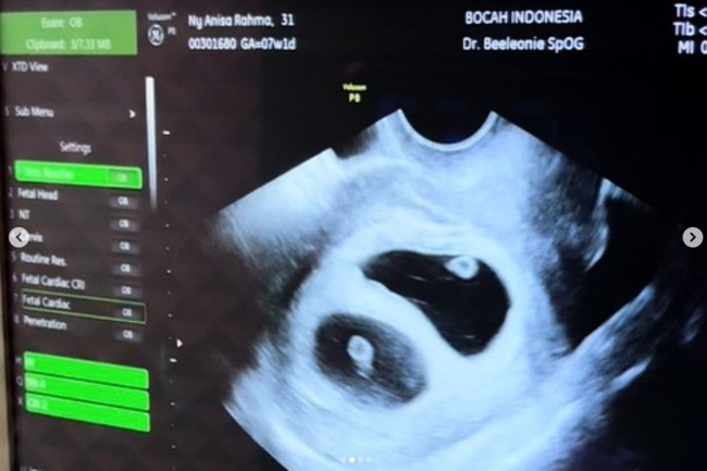 Personel grup vokal Adam Musik ini masih tidak menyangka ia dan Anisa dikaruniai anak kembar. Ia tak henti mengucapkan rasa syukur. Sejak pernikahan kami masih berusia 9 bulan, secara medis kami disebutkan sulit mempunyai buah hati secara normal.. Selama 4th ini berikhtiar dan berdoa agar harapan kami terkabulkan. Sayanggg @anisarahma_12 ..bener kan ini kita dikasih bayi kembar? masih ga nyangka Ya Allah langsung duaaa.. MasyaAllah Tabarakallah.. Sosok istri luarbiasa yang kuat @anisarahma_12 sehat selalu ya sayang..semoga Allah jaga kamu dan bayi kembar kita😭😭🤲🏻, ungkap Dito. Foto: Dok. pribadi @anisarahma_12.