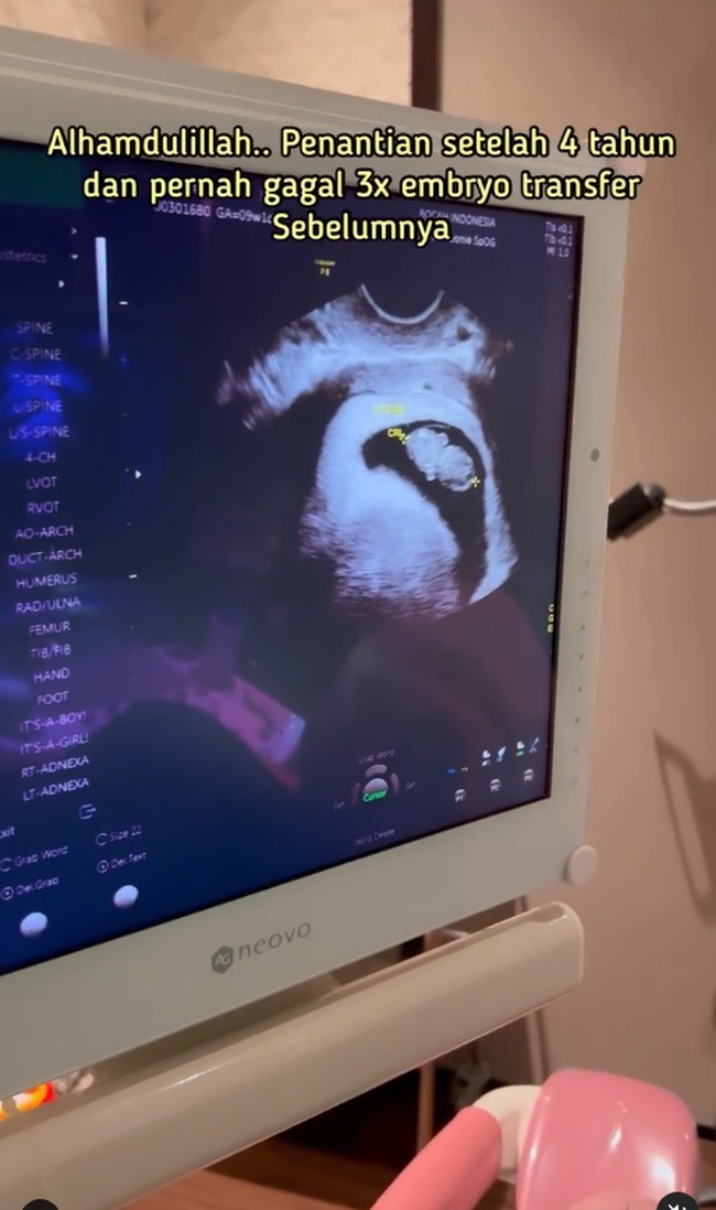 Dito pun juga meluapkan rasa bahagianya karena akan menjadi seorang bapak. Dito membuat video perjalanan proses bayi tabung di akun Instagramnya @ananditodwis. OPU (Ovum Pick Up) 31 Agustus 2021. 24 Februari 2022 menjalani frozzen embryo transfer. Ada 3 embryo yang sudah siap dimasukkan ke dalam rahim. Allahu Akbar!! Kembar MasyaAllah, tulisnya. Foto: Dok. Instagram @ananditodwis.