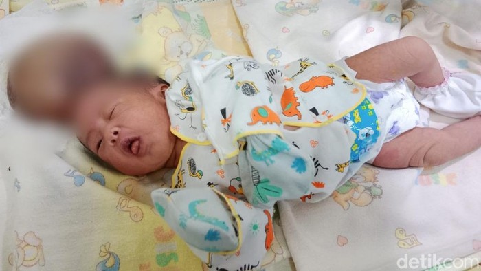 Bupati Ciamis kunjungi bayi benjol di kepala mirip kembar Siam. Foto bayi yang mengalami benjolan di kepala seukuran kepala.