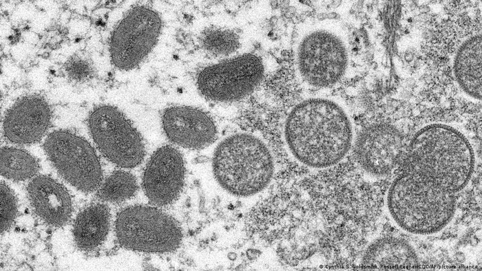 Penyebaran Infeksi Virus Cacar Monyet Terjadi di Eropa dan AS