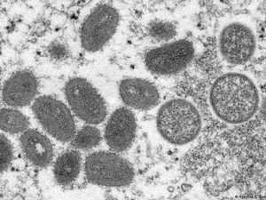 Epidemiolog Sebut Cacar Monyet Bisa Menular Cepat