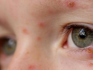 Virus Herpes Terus Mengintai untuk Aktif Kembali dan Menyerang Tubuh