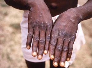 WHN Tandingan WHO Tetapkan Cacar Monyet Jadi Pandemi, Epidemiolog: Tidak Sah!