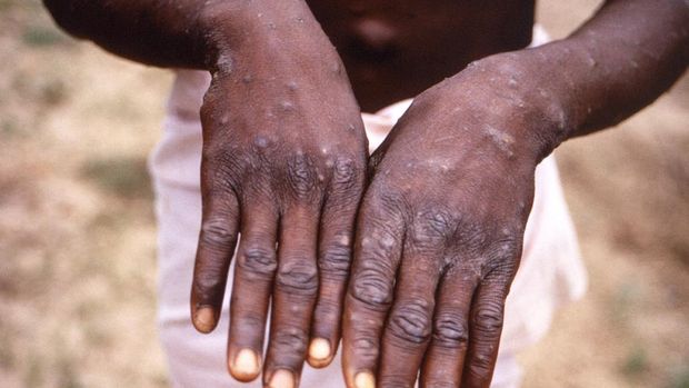 Sebuah gambar yang dibuat selama penyelidikan wabah cacar monyet, yang terjadi di Republik Demokratik Kongo (DRC), 1996 hingga 1997, menunjukkan tangan seorang pasien dengan ruam akibat cacar monyet. (via REUTERS/CDC/BRIAN W.J. MAHY)