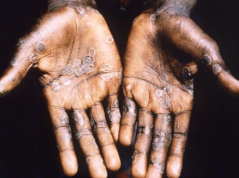 The palm of a monkeypox patient from Lodja, a town located within the Katako-Kombe Health Zone, is seen during a health investigation in the Democratic Republic of Congo in 1997. (via REUTERS/CDC)