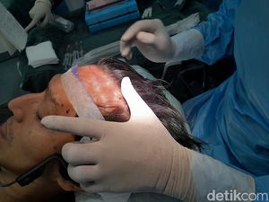 Perlu Tahu, Ini Pantangan usai Transplantasi Rambut