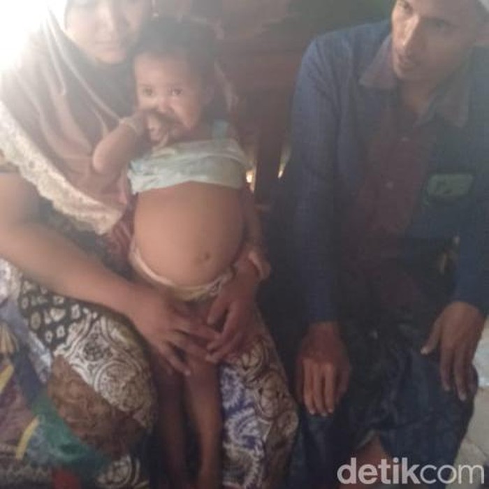 Balita di Sampang idap kanker ginjal