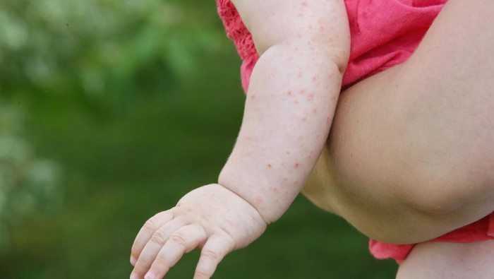 Dokter Ungkap Gejala Flu Singapura yang Lagi Ngegas di RI, Waspada Jika Keluhkan Ini