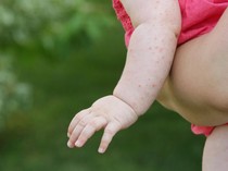 6 Perbedaan Bintik Merah DBD dan Biang Keringat, Jangan Keliru Lagi!