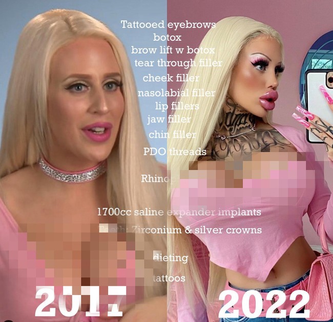 Dan inilah penampilan before after-nya. Dulu dan sekarang seperti dua orang yang berbeda karena dia terlalu mengubah kontur wajahnya. Foto: dok. Instagram