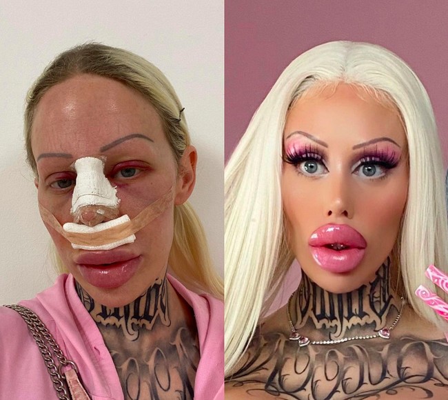 Sebelum operasi plastik, Alicia punya wajah yang manis. Penampilannya dulu berbebda jauh dari saat ini. Di Instagramnya, Alicia pun tak ragu memperlihatkan keadaan wajahnya yang lebam dan masih ditutupi perban setelah operasi plastik. Foto: dok. Instagram