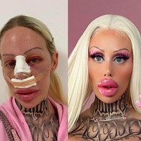 Sebelum operasi plastik, Alicia punya wajah yang manis. Penampilannya dulu berbebda jauh dari saat ini. Di Instagramnya, Alicia pun tak ragu memperlihatkan keadaan wajahnya yang lebam dan masih ditutupi perban setelah operasi plastik. Foto: dok. Instagram