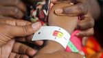 Gizi Buruk Hantui Anak-anak Somalia