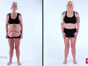 Curhatan Sedih Wanita Turun BB Sampai 107 Kg, Begini Kondisi Kulit Perutnya